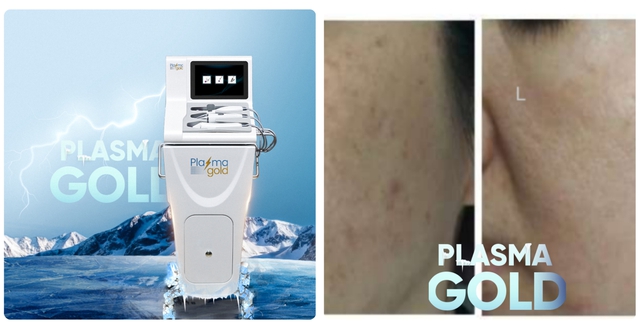 Hướng dẫn sử dụng máy Plasma Gold trong làm đẹp trị sẹo hiệu quả tối ưu - Ảnh 3. Hướng dẫn sử dụng máy Plasma Gold trong làm đẹp trị sẹo hiệu quả tối ưu - Ảnh 3.