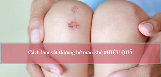 Hướng dẫn c&aacute;ch l&agrave;m vết thương hở mau kh&ocirc;, nhanh l&agrave;nh v&agrave; ngừa sẹo ngay tại nh&agrave;- Ảnh 1.