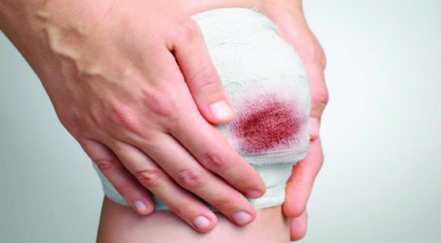 Hướng dẫn c&aacute;ch l&agrave;m vết thương hở mau kh&ocirc;, nhanh l&agrave;nh v&agrave; ngừa sẹo ngay tại nh&agrave;- Ảnh 3.