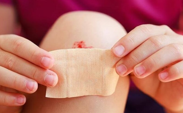 Hướng dẫn c&aacute;ch l&agrave;m vết thương hở mau kh&ocirc;, nhanh l&agrave;nh v&agrave; ngừa sẹo ngay tại nh&agrave;- Ảnh 8.