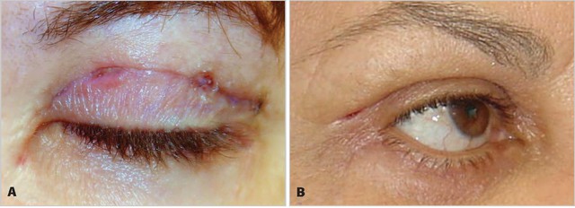 Chia sẻ c&aacute;ch chăm s&oacute;c vết thương sau cắt m&iacute; ngăn ngừa sẹo xấu từ chuy&ecirc;n gia - Ảnh 2.