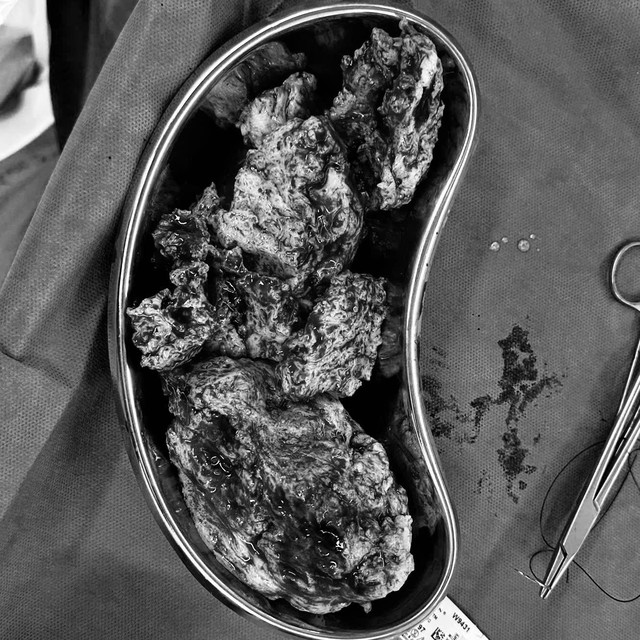 Giữ tử cung th&agrave;nh c&ocirc;ng sau ca mổ lạc nội mạc tử cung  tại Phương Nam - Ảnh 1.