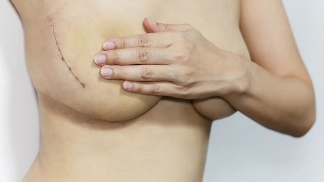 Cách chăm sóc vết thương sau phẫu thuật ngực chuẩn y khoa ngừa sẹo tối đa - Ảnh 5.