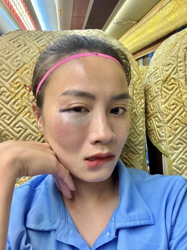 &lsquo;Hot girl&rsquo; đội tuyển nữ Việt Nam chia sẻ khu&ocirc;n mặt bầm t&iacute;m v&igrave; thi đấu, fan x&oacute;t xa- Ảnh 1.