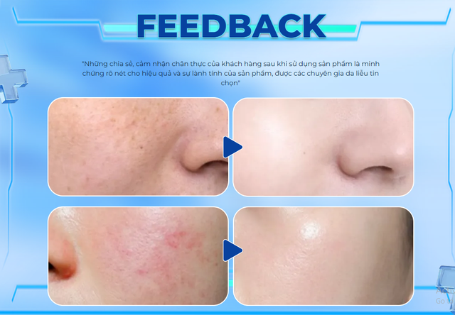 Gợi ý các bước chăm sóc da mụn với Trioderma chuẩn chuyên gia da láng mịn - Ảnh 3.