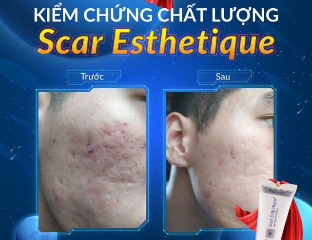 Kh&ocirc;ng laser, kh&ocirc;ng kim: Giải ph&aacute;p khoa học b&ocirc;i thoa cho sẹo rỗ mụn  - Ảnh 4.