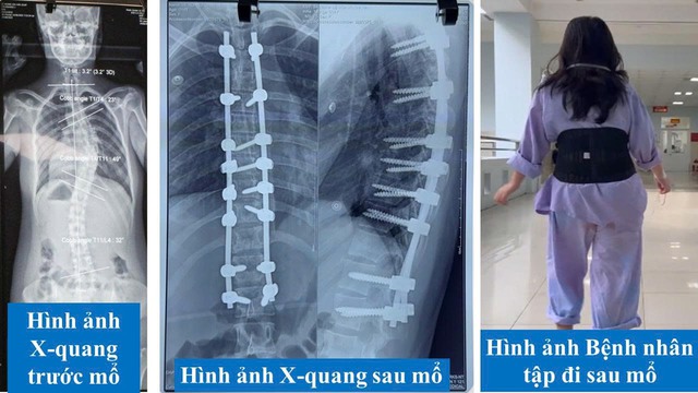 Bệnh viện Quân y 121 điều trị thành công bệnh cong vẹo cột sống - Ảnh 4.