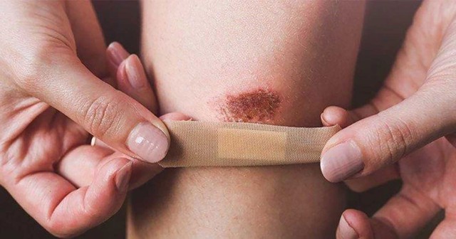 Qu&aacute; tr&igrave;nh l&agrave;nh thương như thế n&agrave;o, phương ph&aacute;p gi&uacute;p phục hồi nhanh ngừa sẹo tối ưu? - Ảnh 3.