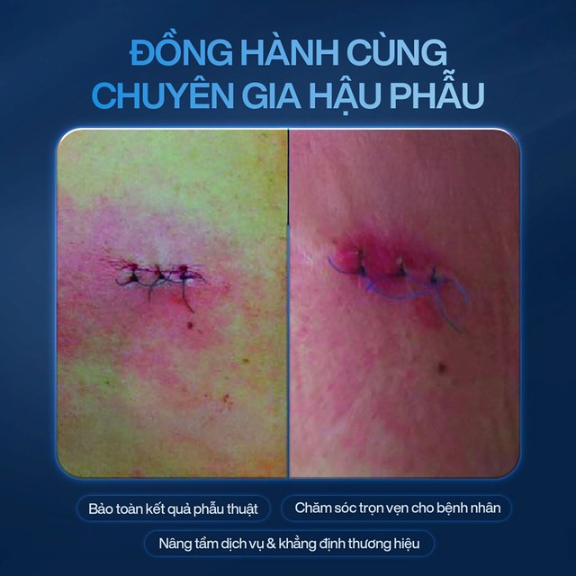 Plasma Lạnh c&oacute; thật sự gi&uacute;p diệt khuẩn cho vết thương mau l&agrave;nh, ngừa sẹo hiệu quả?- Ảnh 5.