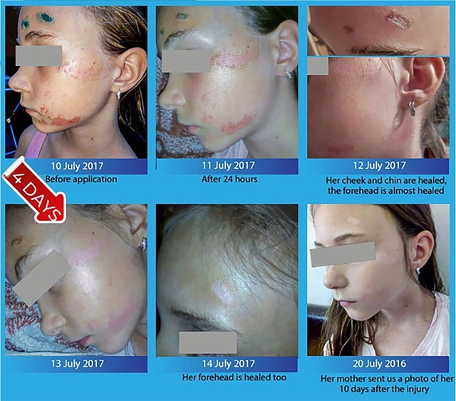 Qu&aacute; tr&igrave;nh l&agrave;nh thương như thế n&agrave;o, phương ph&aacute;p gi&uacute;p phục hồi nhanh ngừa sẹo tối ưu? - Ảnh 7.