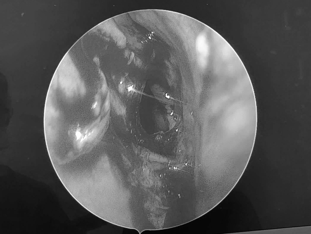 Đ&agrave; Nẵng: Cụ &ocirc;ng mất thị lực v&igrave; khối u nhầy xoang bướm x&acirc;m lấn - Ảnh 1.