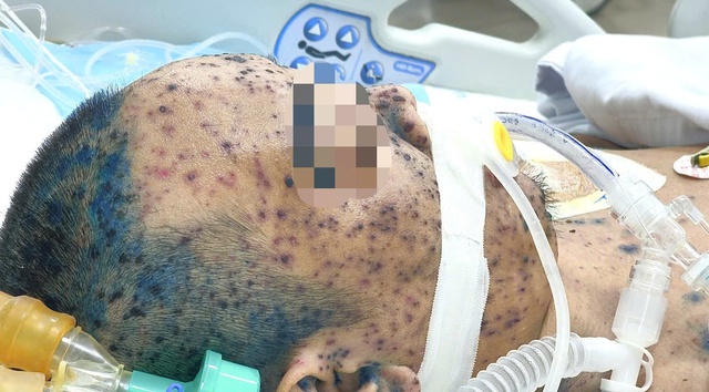 Người đ&agrave;n &ocirc;ng nguy kịch sau khi tự d&ugrave;ng thuốc, truyền dịch điều trị thủy đậu- Ảnh 1.