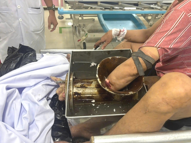 TP.HCM: Bị m&aacute;y xay thịt 'nuốt chửng' tay, phải đưa cả người v&agrave; m&aacute;y v&agrave;o ph&ograve;ng mổ- Ảnh 1.