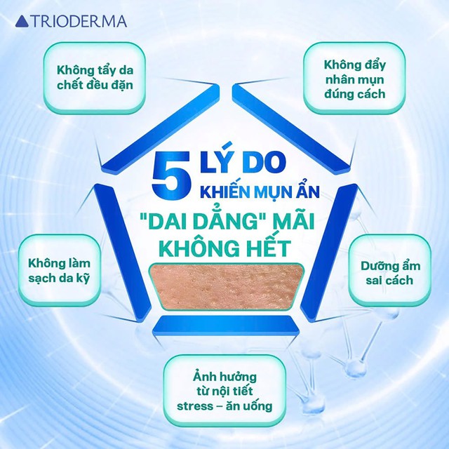 Mụn s&acirc;u tới đ&acirc;u cũng đ&aacute;nh bật, kh&ocirc;ng sẹo nhờ c&aacute;ch ngừa mụn ẩn chuẩn chuy&ecirc;n gia- Ảnh 3.