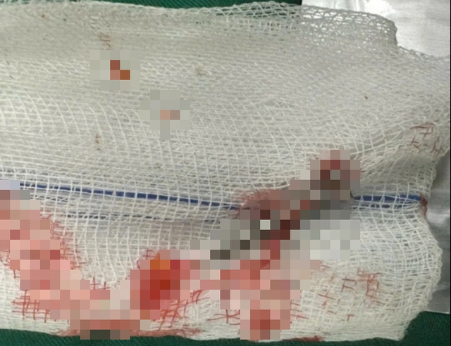 Quảng Trị: Phẫu thuật nam thanh niên bị súng bắn đinh bắn thủng ruột non - Ảnh 1.