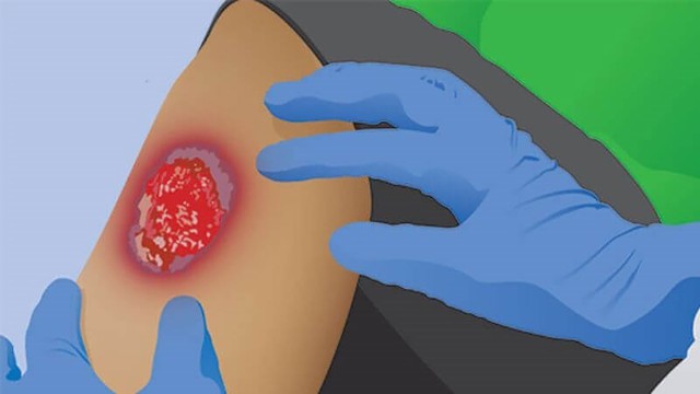 Xịt vết thương mạn tính Hemacut Spay có tốt không? - Ảnh 2.