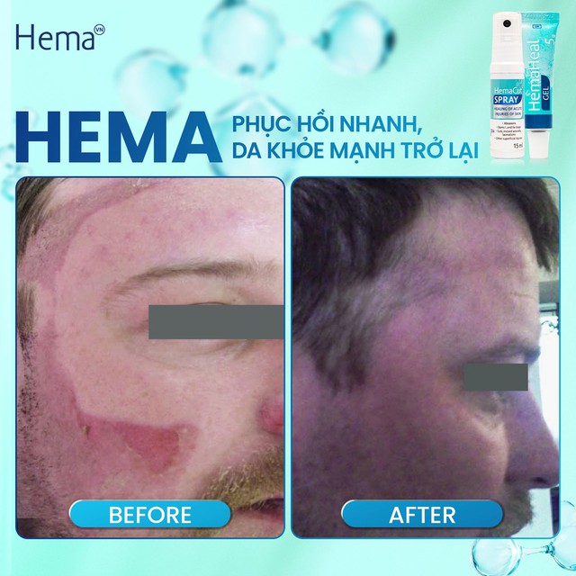 Xịt vết thương mạn tính Hemacut Spay có tốt không? - Ảnh 6.