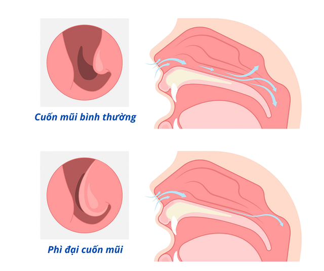Giải ph&oacute;ng đường thở cho người đ&agrave;n &ocirc;ng nghẹt mũi 5 năm, lệ thuộc thuốc co mạch- Ảnh 2.