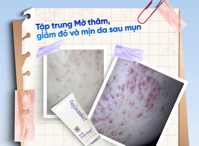 Da mụn breakout: khi nào nên chăm sóc da, khi nào nên đi thẳng đến treatment?- Ảnh 2. Da mụn breakout: khi nào nên chăm sóc da, khi nào nên đi thẳng đến treatment?- Ảnh 2.