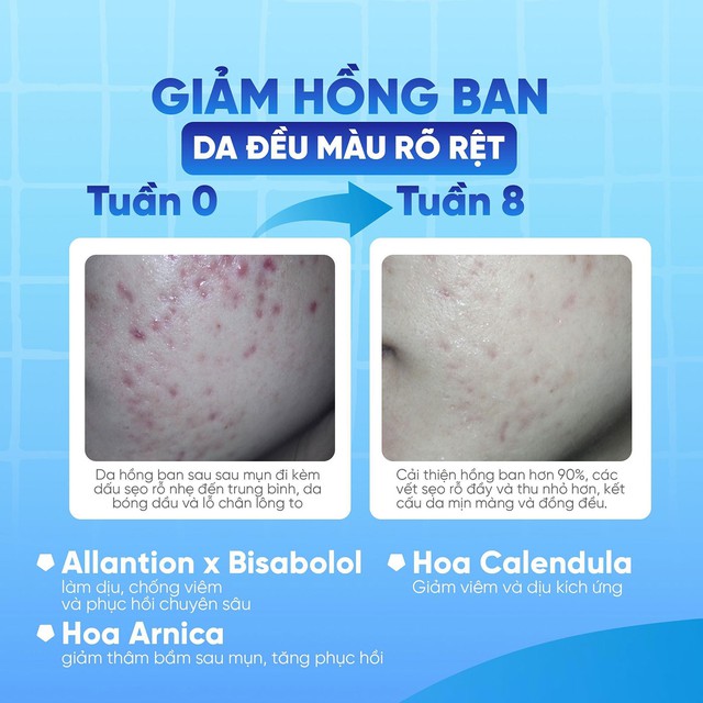 Da sau mụn: Giải m&atilde; tiến tr&igrave;nh phục hồi sinh học dưới g&oacute;c độ chuy&ecirc;n gia- Ảnh 4.