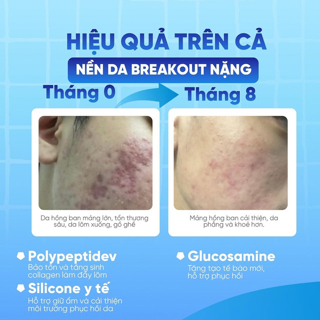 Hiệu quả l&acirc;m s&agrave;ng cho thấy c&ocirc;ng dụng cải thiện nền da sau breakout của Scar Esthetique - Ảnh 4.