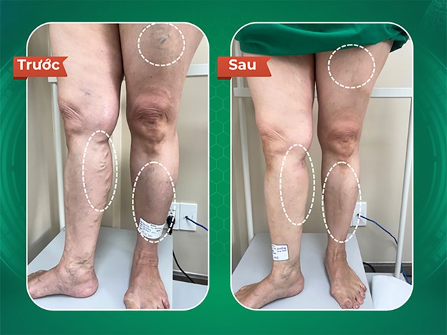 Dr.Vein - Chuyên điều trị giãn tĩnh mạch cho người nước ngoài- Ảnh 2. Dr.Vein - Chuyên điều trị giãn tĩnh mạch cho người nước ngoài- Ảnh 2.
