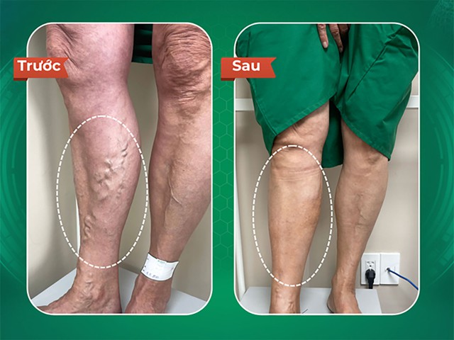 Dr.Vein - Chuyên điều trị giãn tĩnh mạch cho người nước ngoài- Ảnh 3. Dr.Vein - Chuyên điều trị giãn tĩnh mạch cho người nước ngoài- Ảnh 3.
