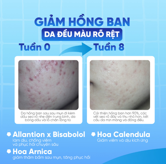 Hướng dẫn sử dụng kem l&agrave;m mờ sẹo rỗ Rejuvaskin Scar Esthetique đ&uacute;ng chuẩn y khoa - Ảnh 2.