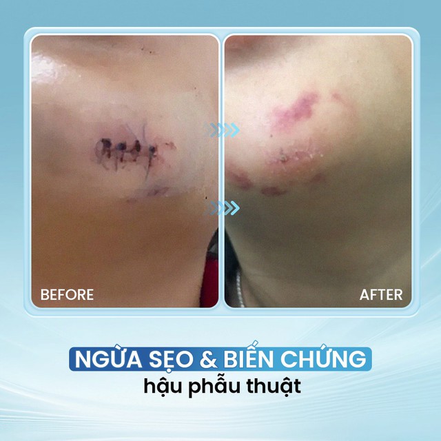 Xịt hỗ trợ lành thương HemaCut Spray mua ở đâu chính hãng, giá tốt? - Ảnh 4.