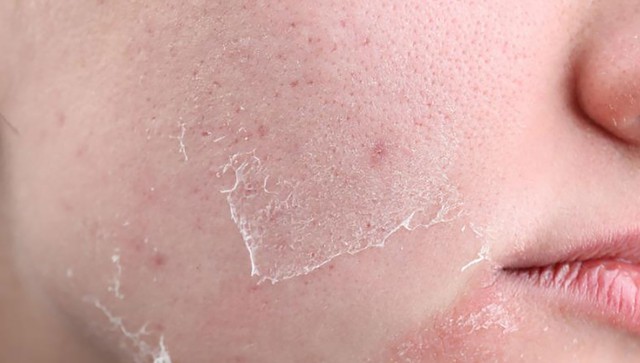 Ghim ngay: Tu&yacute;p kem đang được Gen Z &lsquo;vote cao&rsquo; cho sẹo mụn! - Ảnh 5.