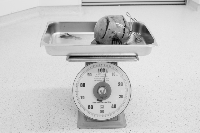 Phẫu thuật cắt tử cung vì khối u xơ khổng lồ nặng hơn 4 kg - Ảnh 3.