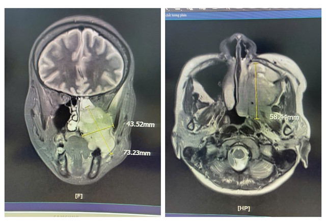 Đau h&agrave;m, nghẹt mũi, chảy m&aacute;u răng - Đi kh&aacute;m ph&aacute;t hiện ung thư xoang- Ảnh 1.