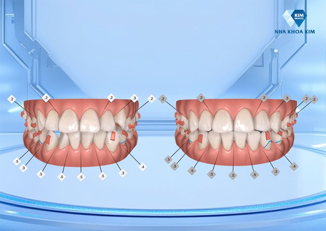 Niềng răng 2026: Khi an to&agrave;n trở th&agrave;nh &lsquo;lựa chọn' đầu tư mới của giới trẻ - Ảnh 2.