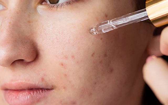 Những lưu ý khi sử dụng các hoạt chất treatment trong chăm sóc da chuyên sâu - Ảnh 3.