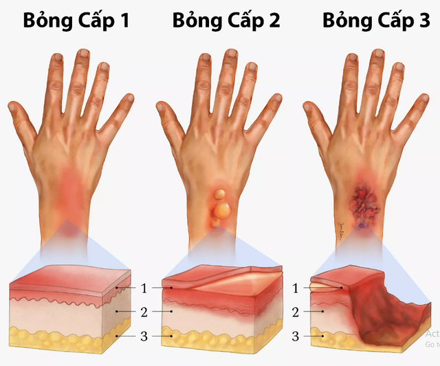 Cứ nghĩ sẹo bỏng phải xâm lấn nhưng dùng kem mờ sẹo vẫn hiệu quả nhanh chóng - Ảnh 2.