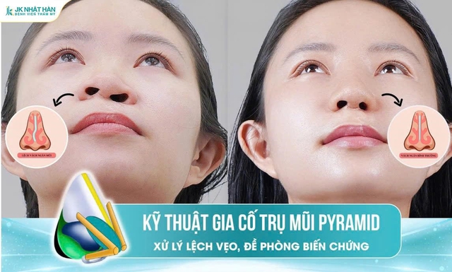 N&acirc;ng mũi sụn sườn J-Cos: Khi n&acirc;ng cao sống mũi vẫn chưa đủ - Ảnh 3.