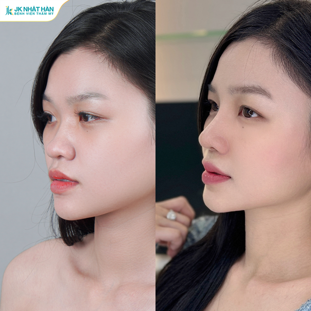N&acirc;ng mũi sụn sườn J-Cos: Khi n&acirc;ng cao sống mũi vẫn chưa đủ - Ảnh 5.