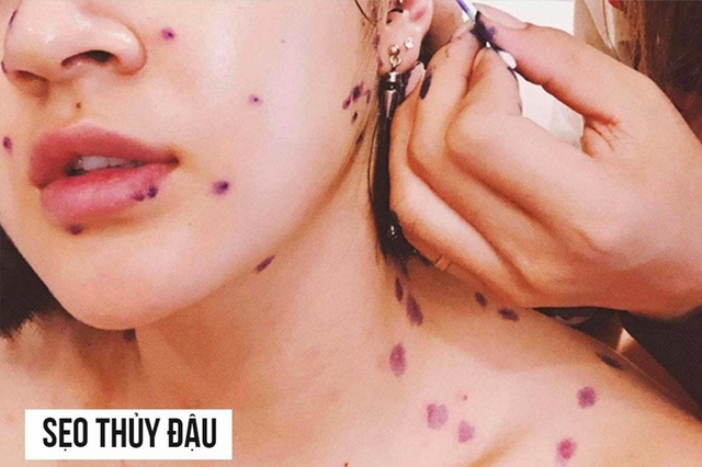 Sẹo thủy đậu: Kem mờ sẹo nào hiệu quả cho cả sẹo thâm và sẹo lõm? - Ảnh 2.