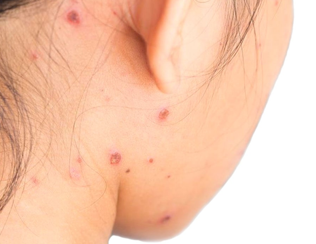 Sẹo thủy đậu: Kem mờ sẹo nào hiệu quả cho cả sẹo thâm và sẹo lõm? - Ảnh 3.