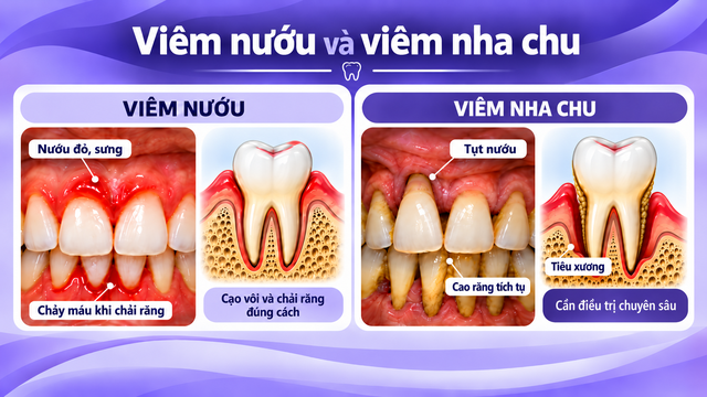 Chảy máu khi đánh răng, nên dừng hay chải nhiều hơn? - Ảnh 2.