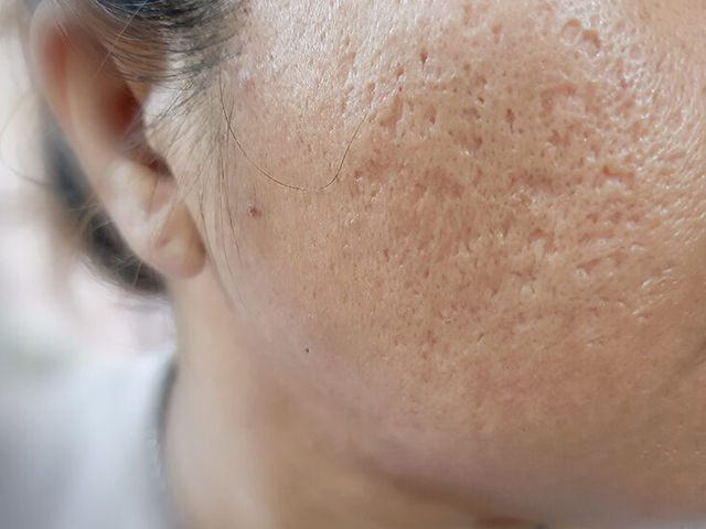 Sẹo trên mặt phải làm sao khi đã dùng đủ loại kem vẫn không cải thiện? - Ảnh 3.