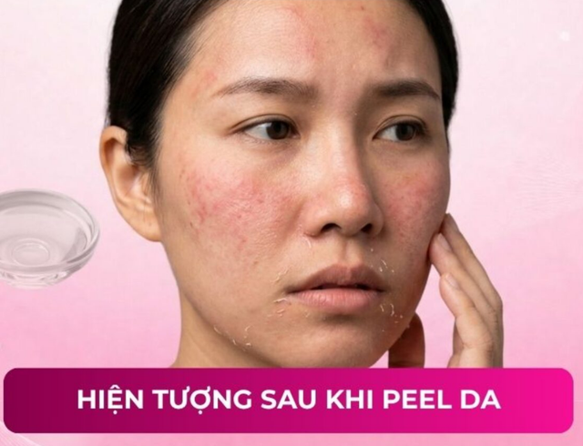Cần làm gì sau khi peel da? Bất ngờ 99% đều làm sai khiến da tổn thương - Ảnh 1.