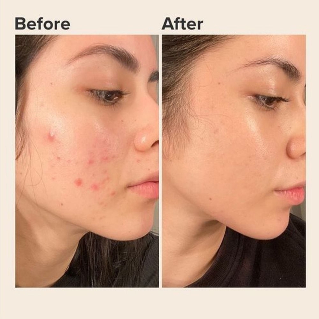 Retinol cho người mới bắt đầu: Đừng để nỗi sợ kích ứng mà quên ‘hoạt chất vàng’ - Ảnh 4.