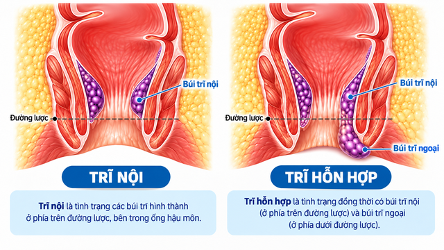 Đi tiêu ra máu kéo dài, người đàn ông phát hiện trĩ kèm thiếu máu nặng - Ảnh 1.