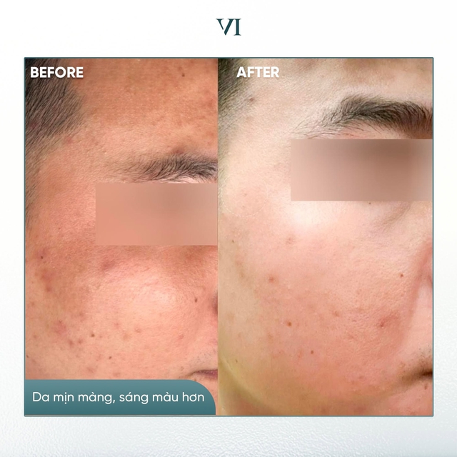 Top 5 kem gi&uacute;p mờ n&aacute;m ch&acirc;n s&acirc;u, đốm n&acirc;u hiệu quả sau khoảng 4 tuần - Ảnh 10.