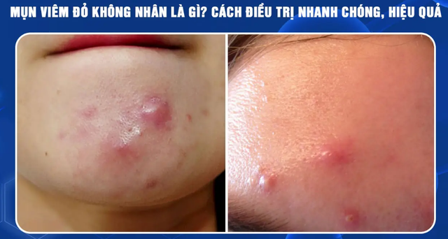 Mụn sưng đỏ không nhân: Càng muốn nặn càng dễ thâm, chấm mụn thế nào mới đúng? - Ảnh 1.