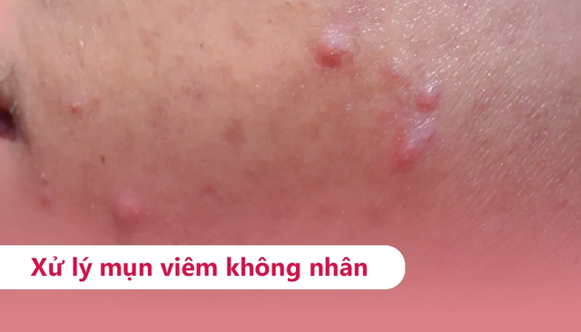 Mụn sưng đỏ không nhân: Càng muốn nặn càng dễ thâm, chấm mụn thế nào mới đúng? - Ảnh 2.