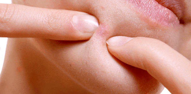 Mụn sưng đỏ không nhân: Càng muốn nặn càng dễ thâm, chấm mụn thế nào mới đúng? - Ảnh 3.