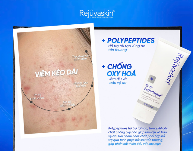 Sẹo rỗ không phải ‘một loại’: vì sao nhiều người điều trị mãi vẫn không đẹp? - Ảnh 5.