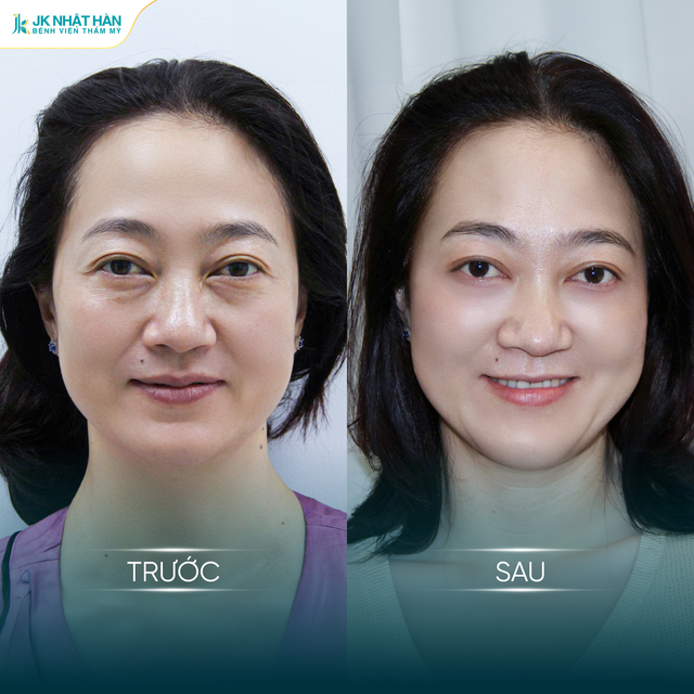 Vì sao nhiều Việt kiều lựa chọn về Việt Nam trẻ hóa vùng mắt? - Ảnh 3.
